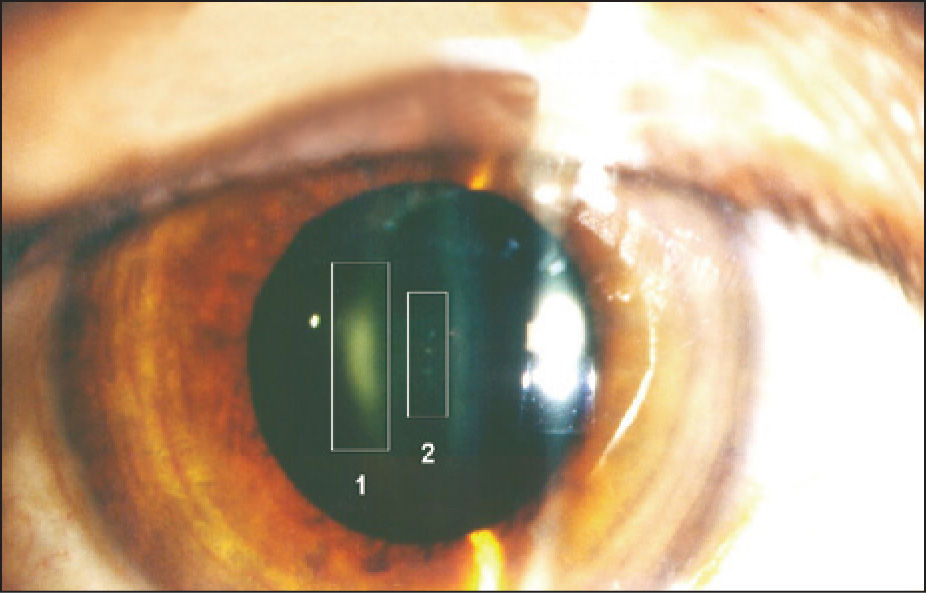 Lentes plomados - Imagen 2
